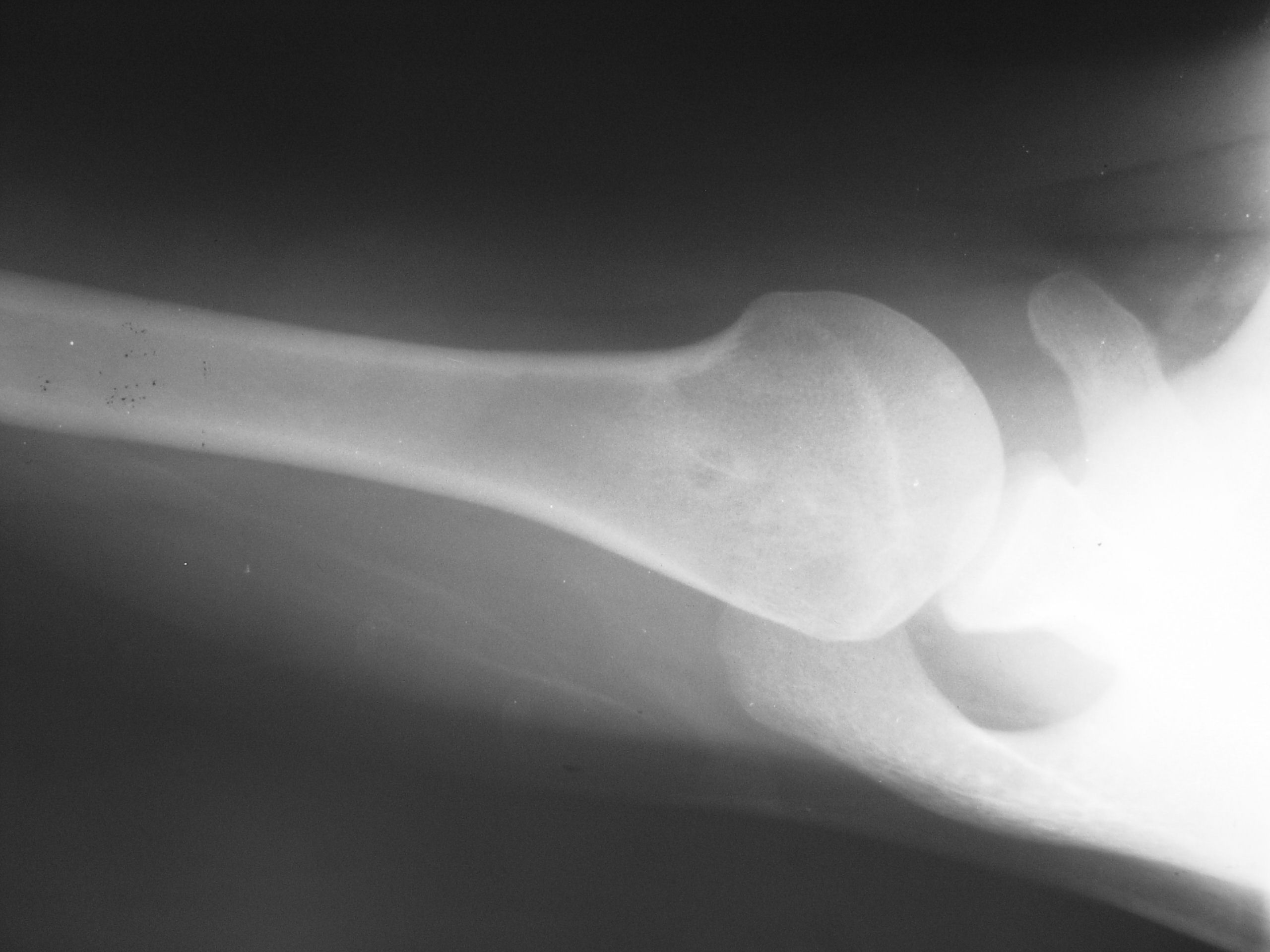Остеоид остеома рентген